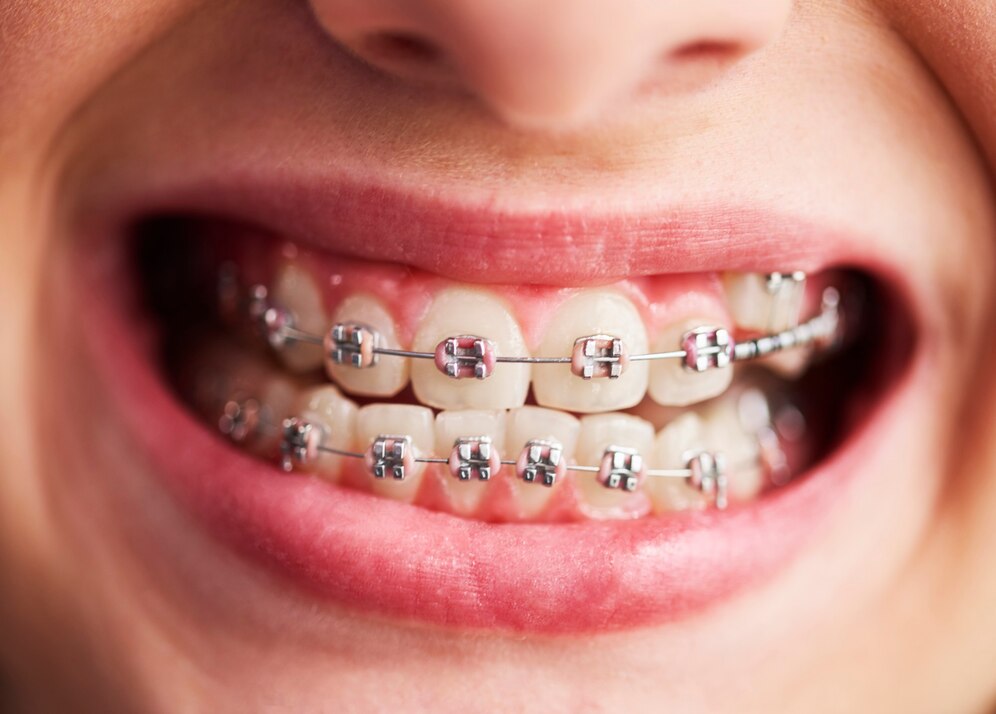 The image shows a person wearing orthodontic braces.