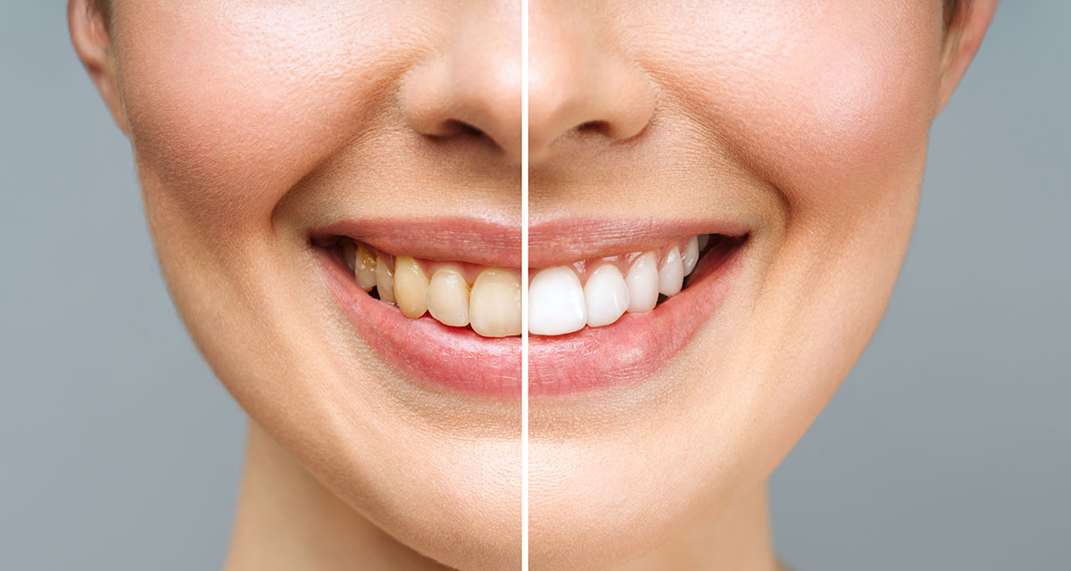 Impressive before and after teeth whitening procedure. Visible transformation, revealing a brighter and more radiant smile. Discover the benefits of professional teeth whitening to achieve whiter teeth and renewed confidence.