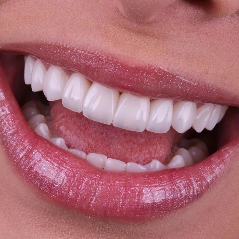 Confiar Odontologia - INVISALIGN Você tomou a decisão de usar os